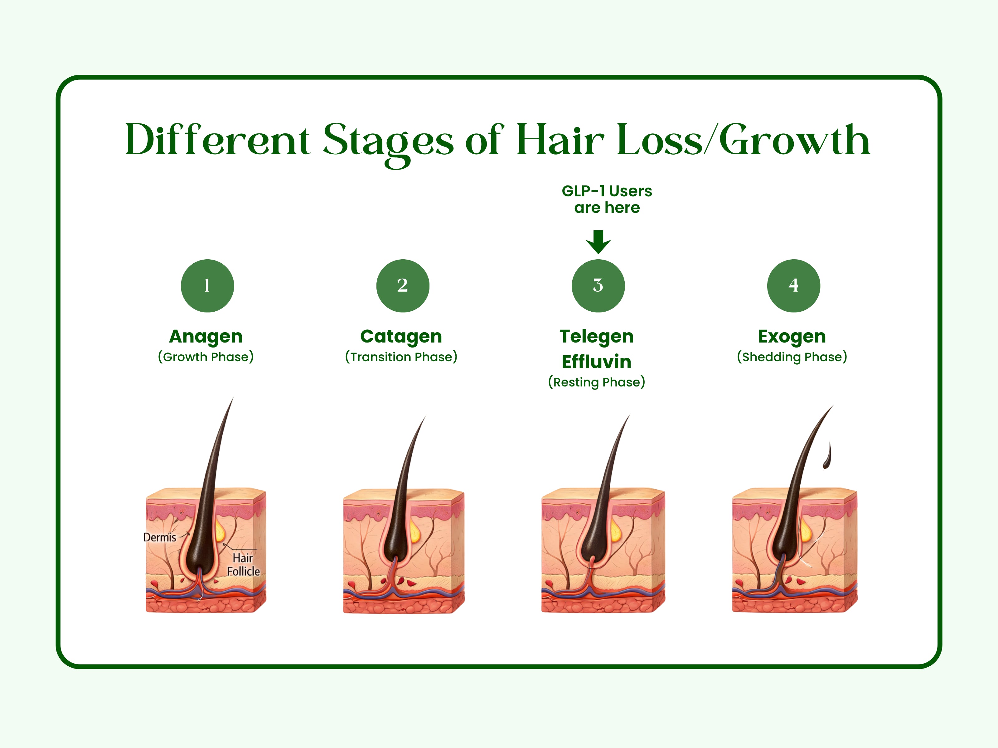 Telogen effluvium hair shedding